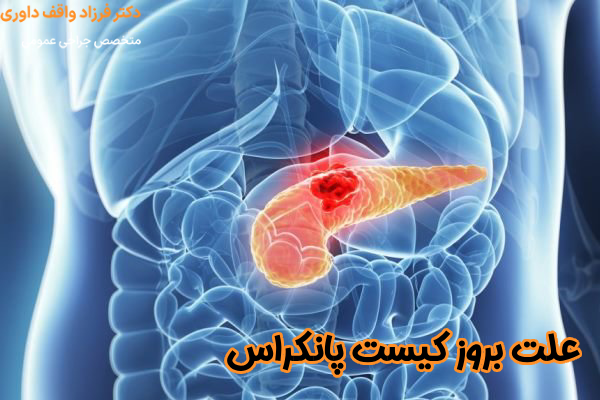 دلایل بروز کیست پانکراس
