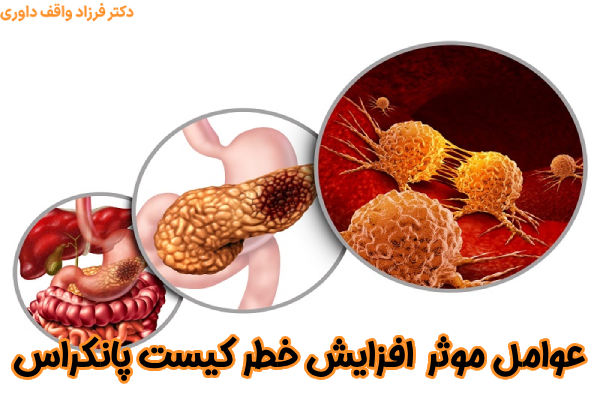 عوامل در افزایش خطر کیست پانکراس