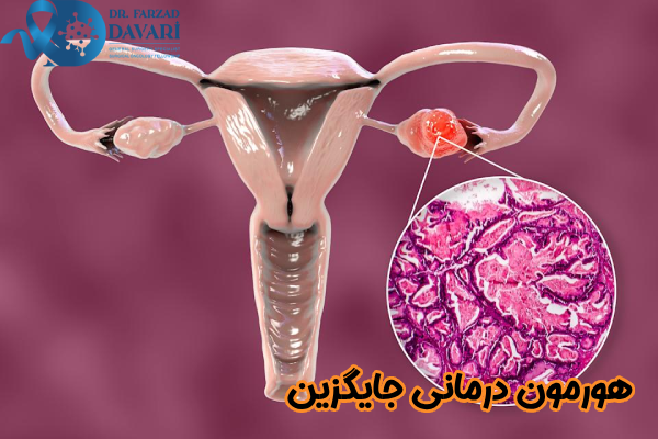 هورمون درمانی جایگزین