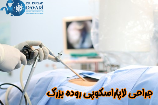 جراحی لاپاراسکوپی روده بزرگ