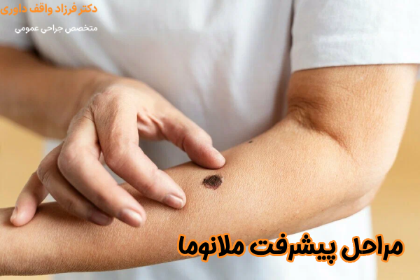مراحل پیشرفت ملانوما