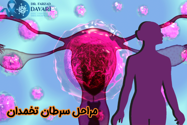 مراحل سرطان تخمدان