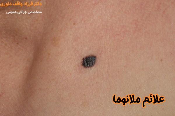 علائم ملانوما