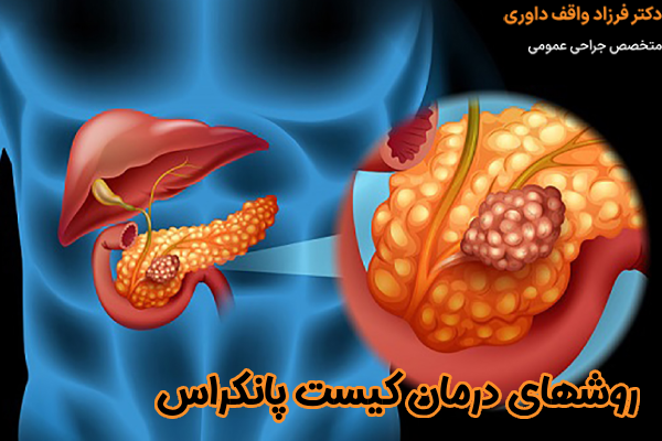 روشهای درمان کیست پانکراس