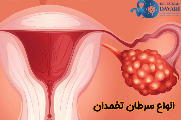 انواع سرطان تخمدان