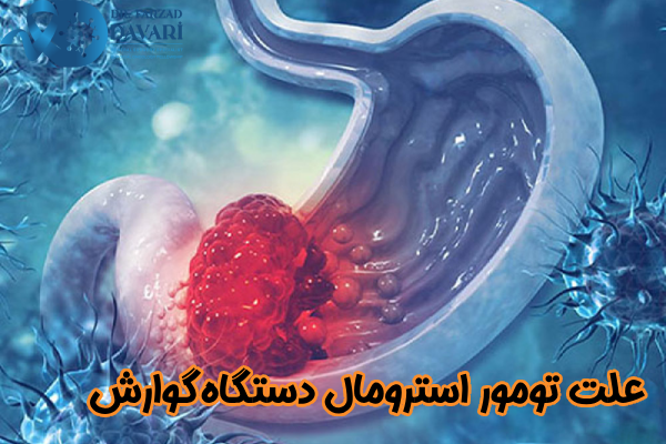 علت تومور استرومال دستگاه گوارش