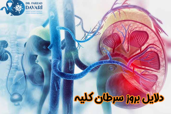 دلایل بروز سرطان کلیه