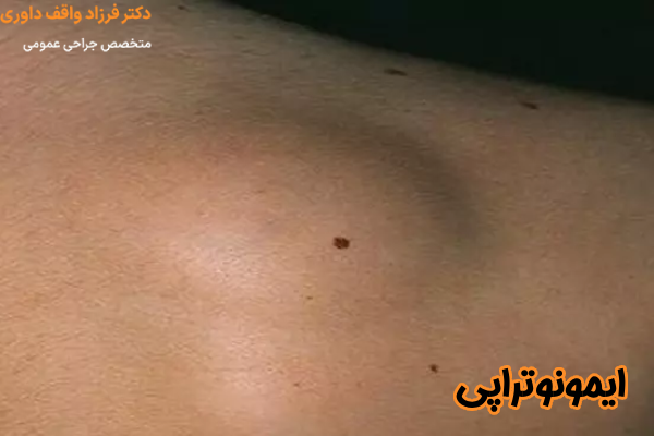 ایمونوتراپی