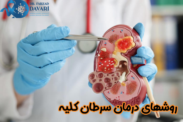 روشهای درمان سرطان کلیه
