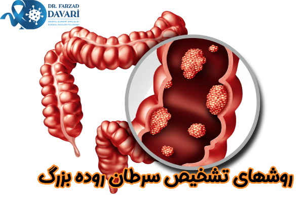 روشهای تشخیص سرطان روده بزرگ