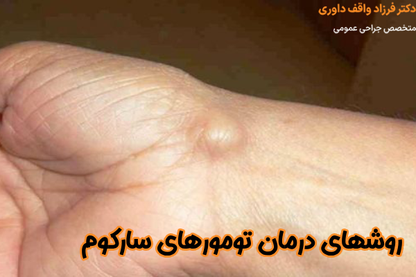 روشهای درمان تومورهای سارکوم