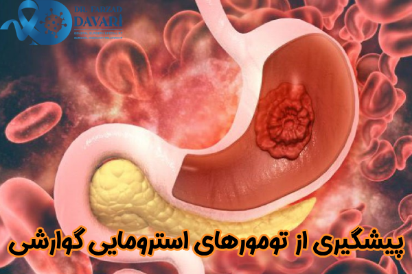 پیشگیری از تومورهای استرومایی گوارشی