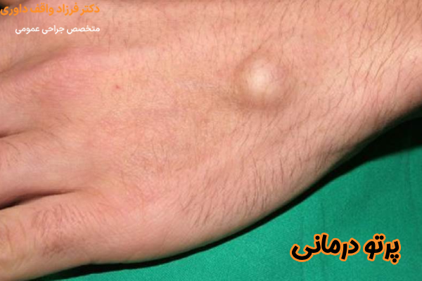 پرتو درمانی برای سارکوم