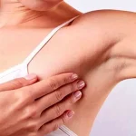 جراحی غدد لنفاوی نگهبان