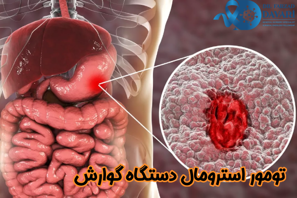 تومورهای GIST دستگاه گوارش چیست