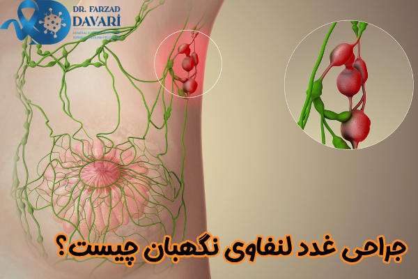 جراحی غدد لنفاوی نگهبان چیست