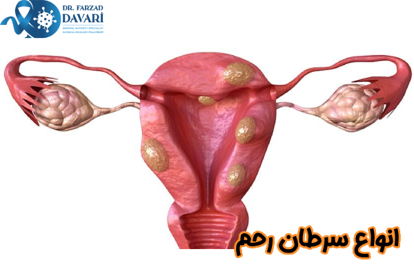 انواع سرطان رحم