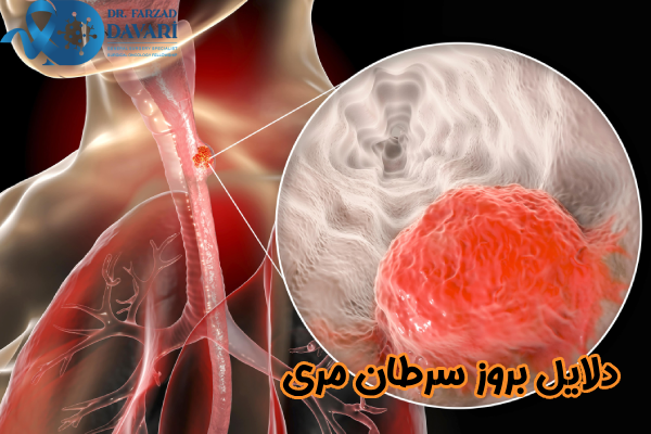 دلایل بروز سرطان مری