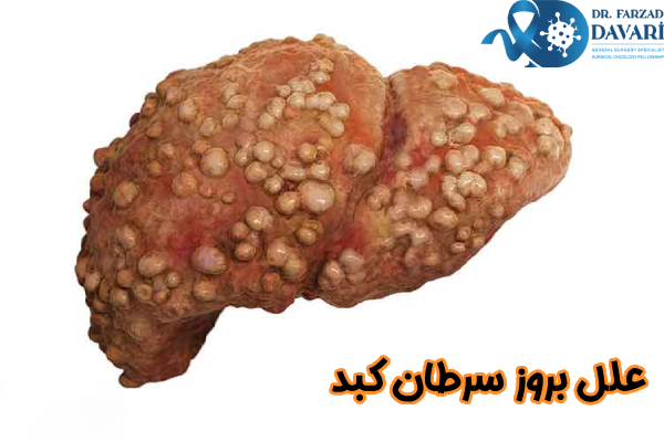 علل بروز سرطان کبد
