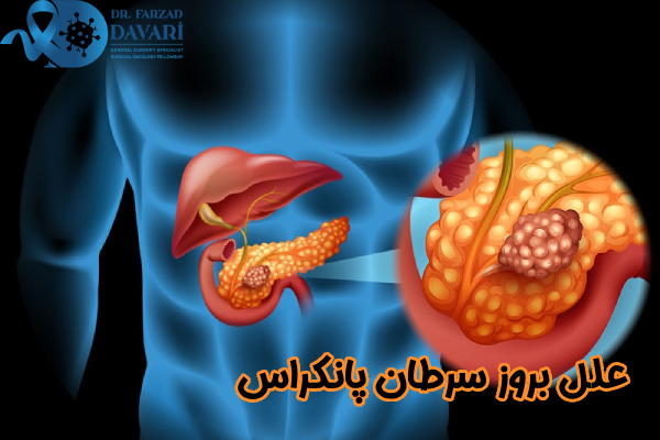 علل بروز سرطان پانکراس