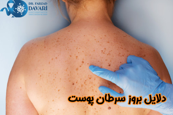 دلایل بروز سرطان پوست