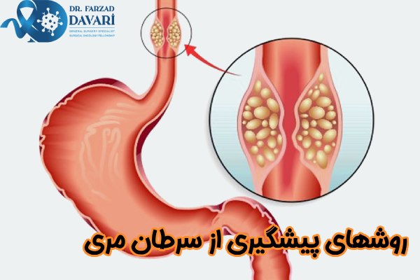 روشهای پیشگیری از سرطان مری
