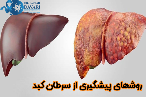 روشهای پیشگیری از سرطان کبد