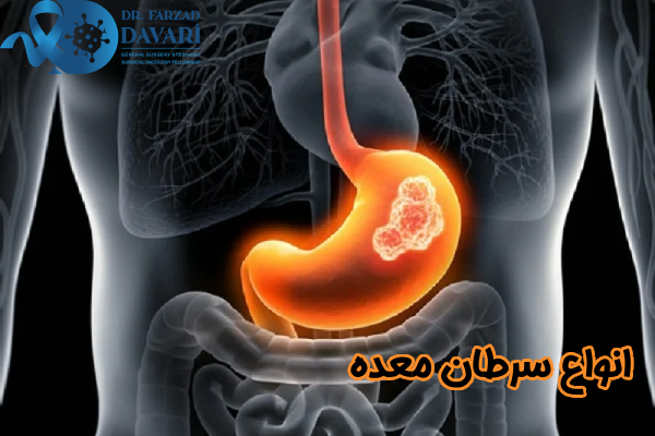 انواع سرطان معده