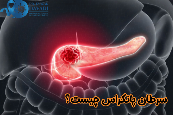 سرطان لوزالمعده چیست