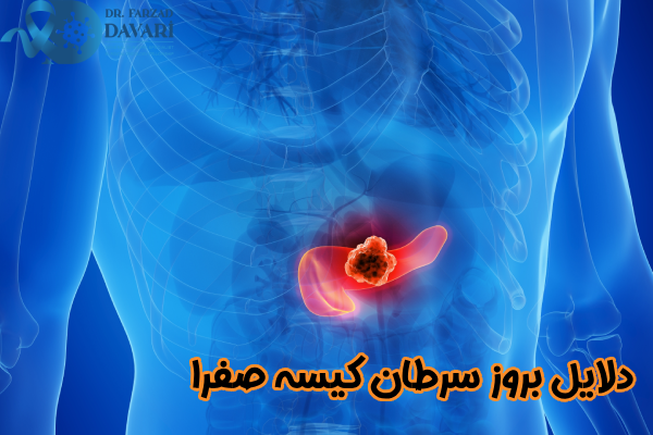 دلایل بروز سرطان کیسه صفرا
