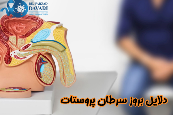 دلایل بروز سرطان پروستات