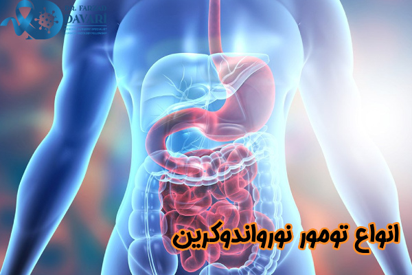 انواع تومور نورواندوکرین