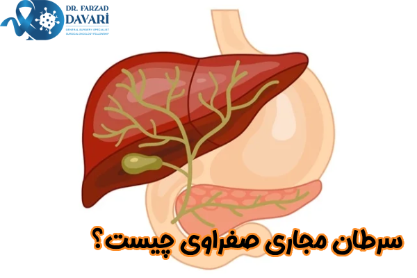 سرطان مجاری صفراوی چیست