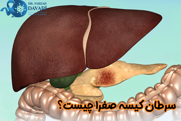 سرطان کیسه صفرا چیست