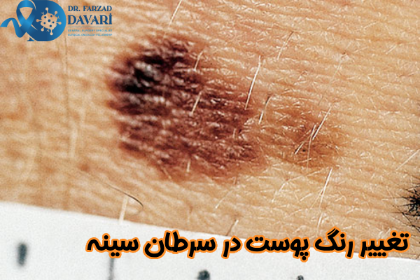تغییر رنگ پوست در سرطان سینه