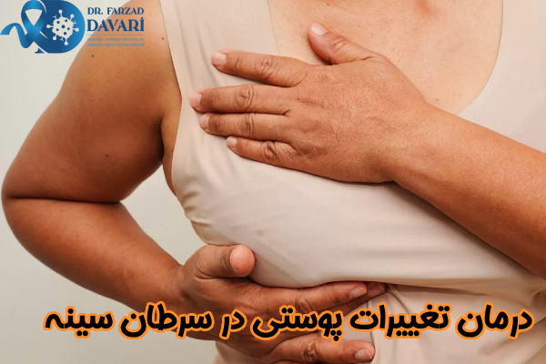 درمان تغییرات پوستی در سرطان سینه