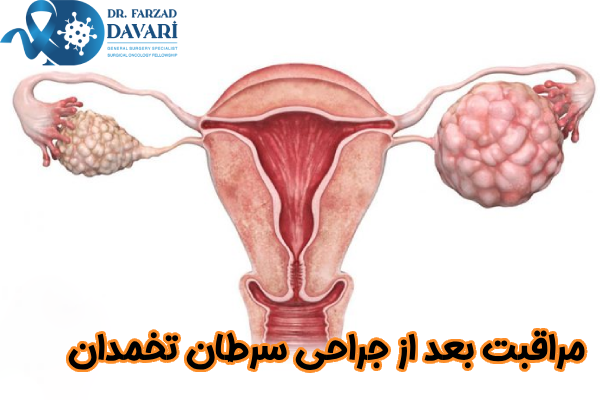 اقدامات بعد از جراحی سرطان تخمدان