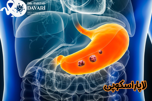 لاپاراسکوپی