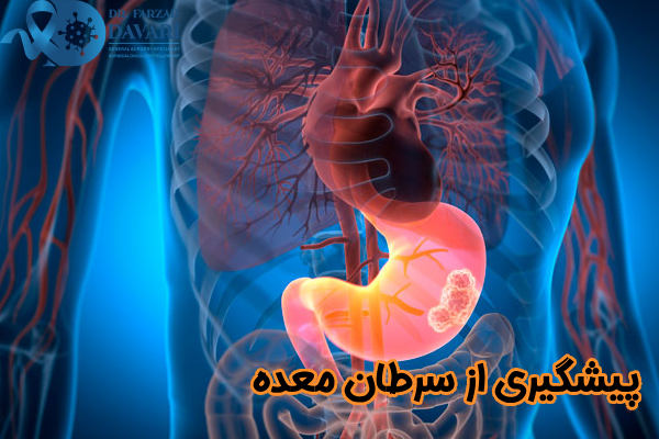 روش های پیشگیری از سرطان معده