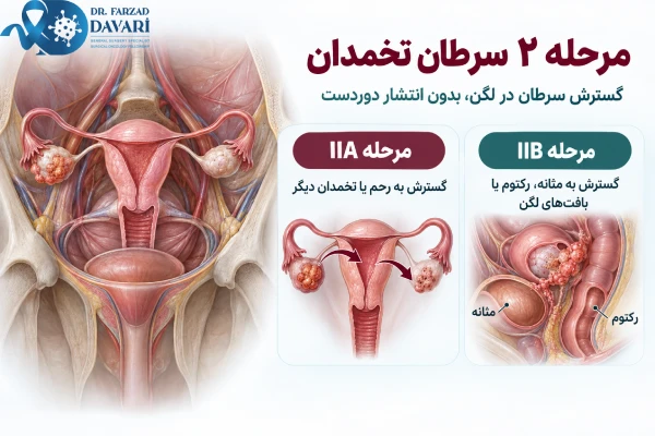 مرحله ۲ سرطان تخمدان