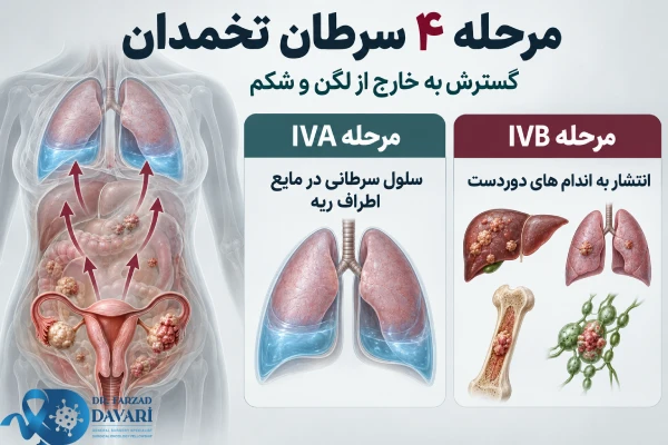 مرحله ۴ سرطان تخمدان